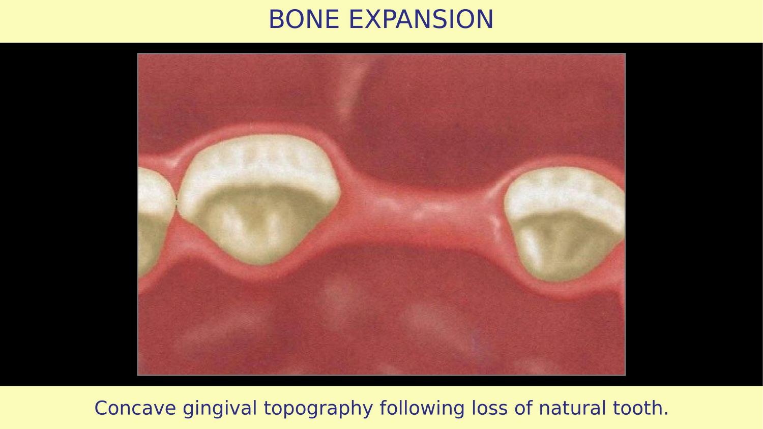 How Osteotomes Should Not Be Used — Part 1 — Slide 2