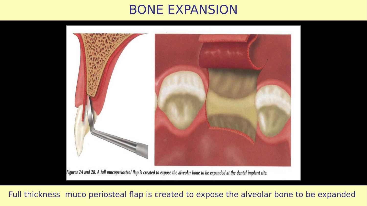 How Osteotomes Should Not Be Used — Part 1 — Slide 3