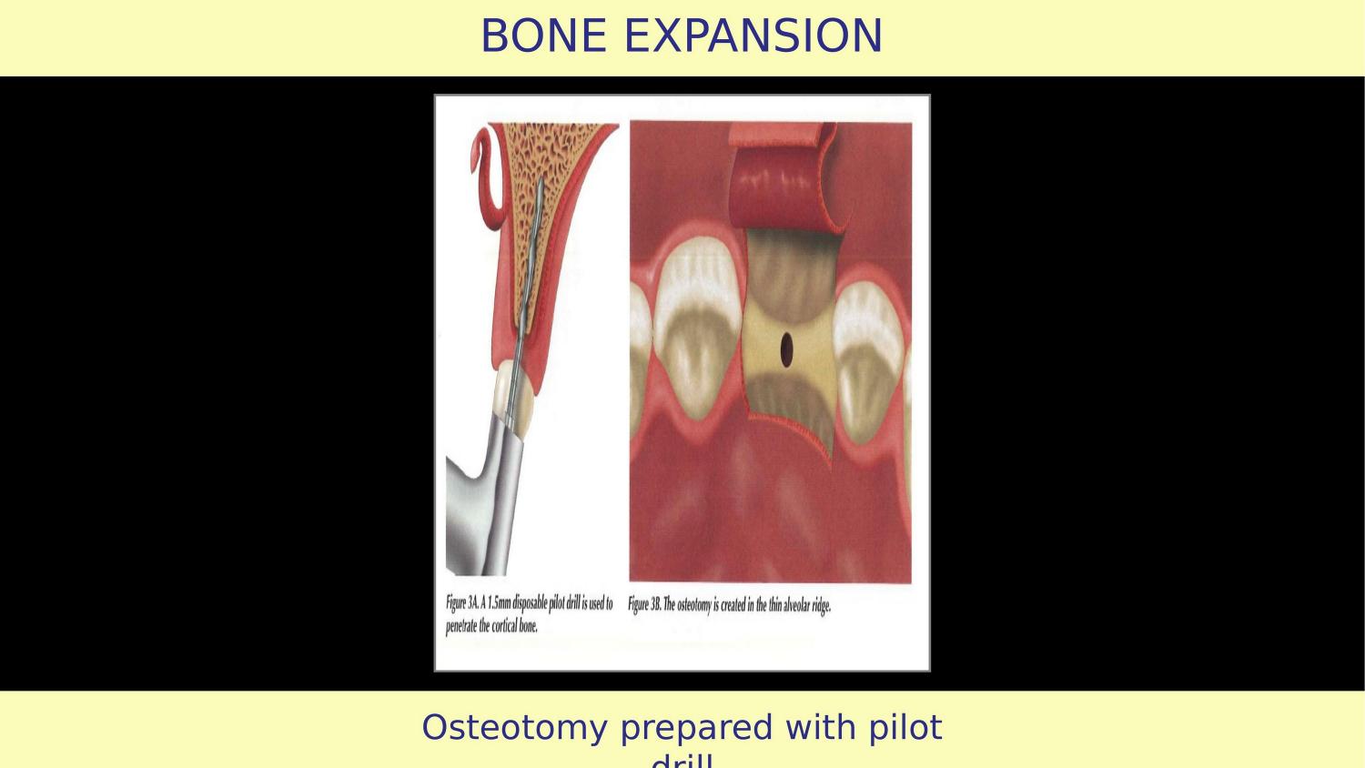 How Osteotomes Should Not Be Used — Part 1 — Slide 4