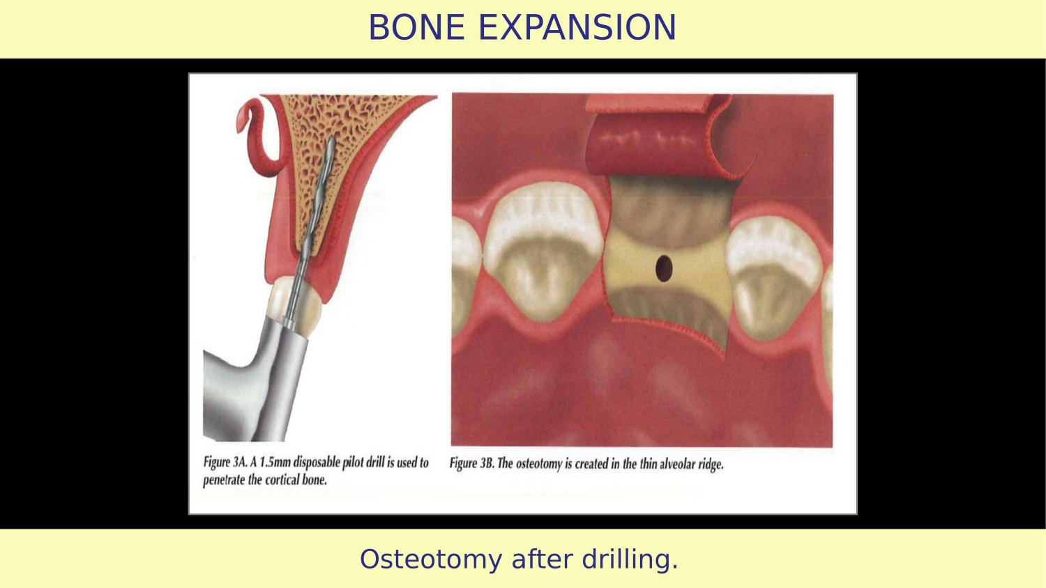 How Osteotomes Should Not Be Used — Part 1 — Slide 6