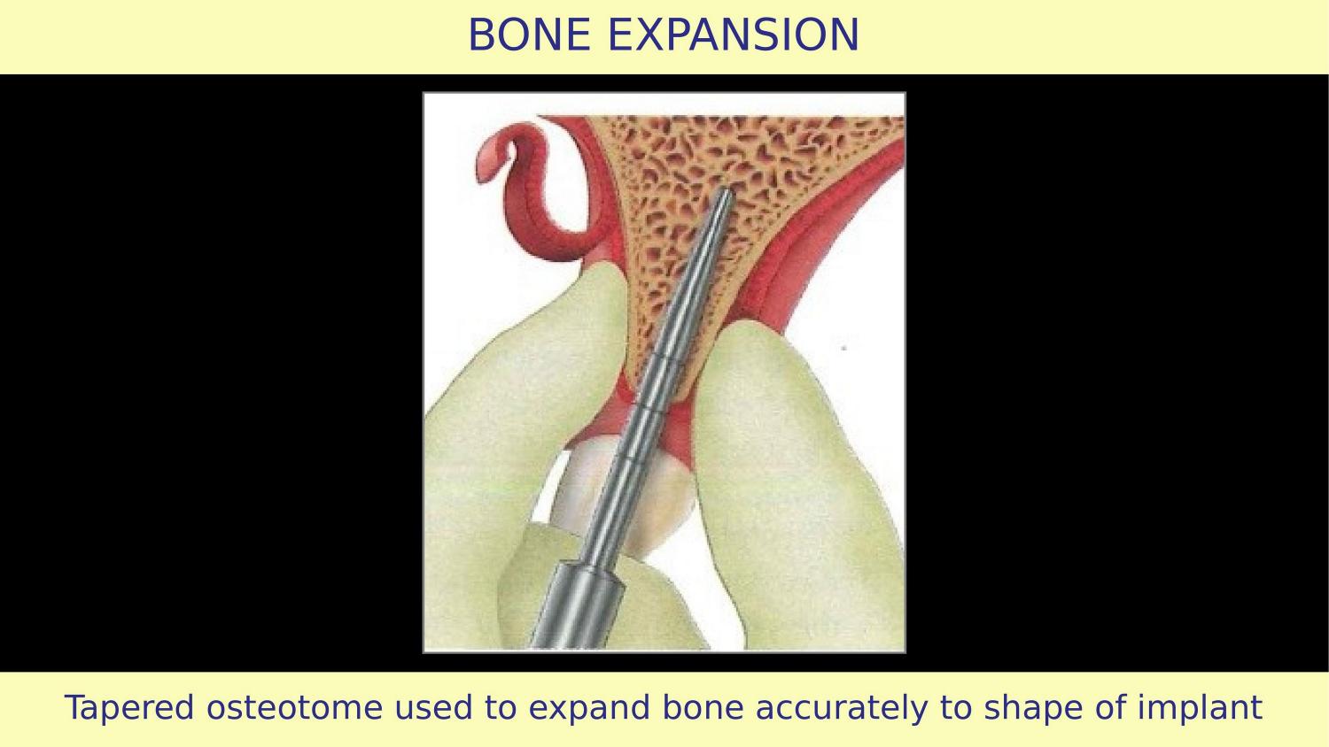 How Osteotomes Should Not Be Used — Part 1 — Slide 7