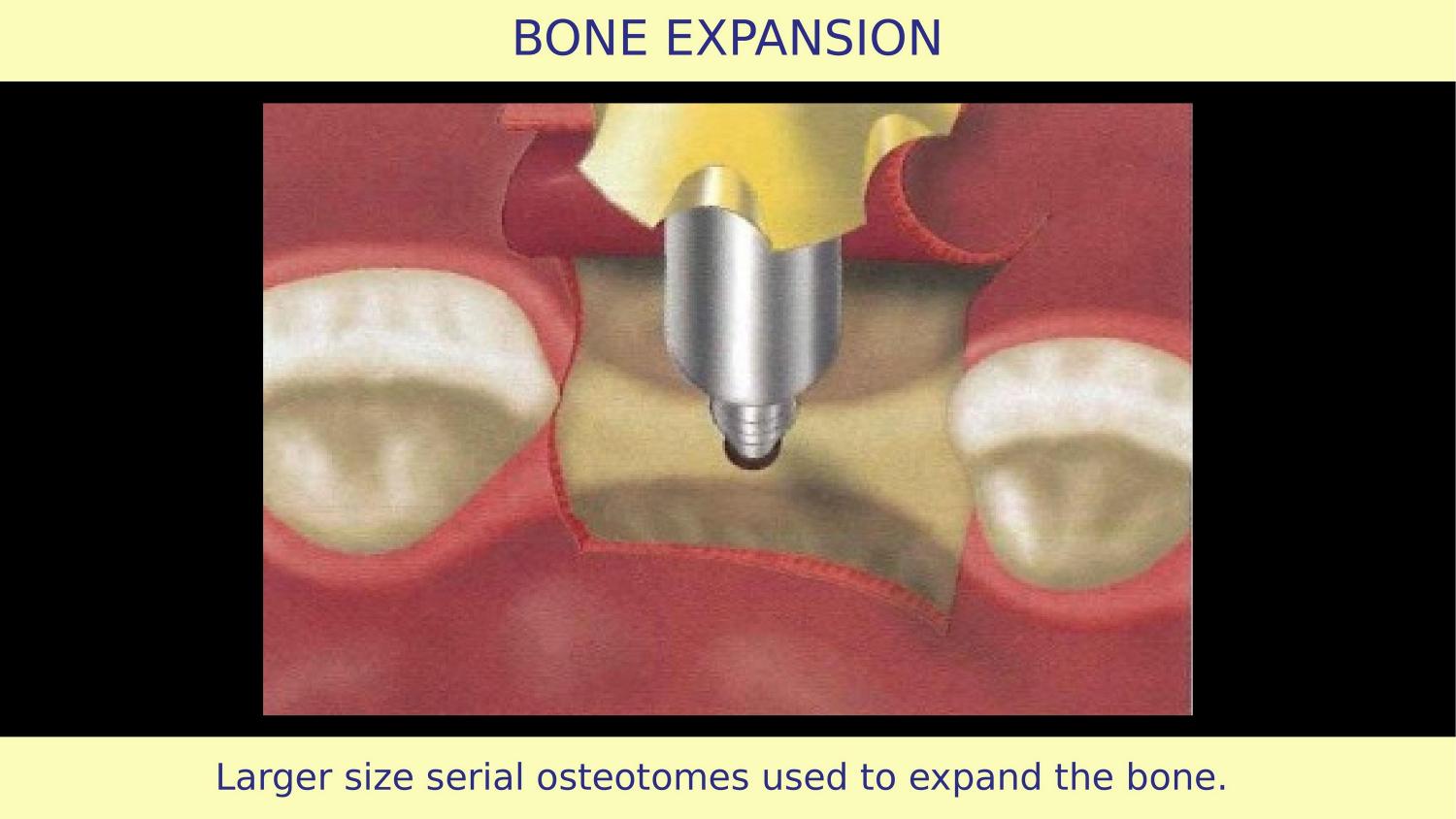 How Osteotomes Should Not Be Used — Part 1 — Slide 9