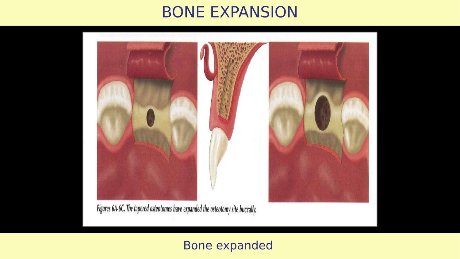How Osteotomes Should Not Be Used — Part 1 — Slide 10