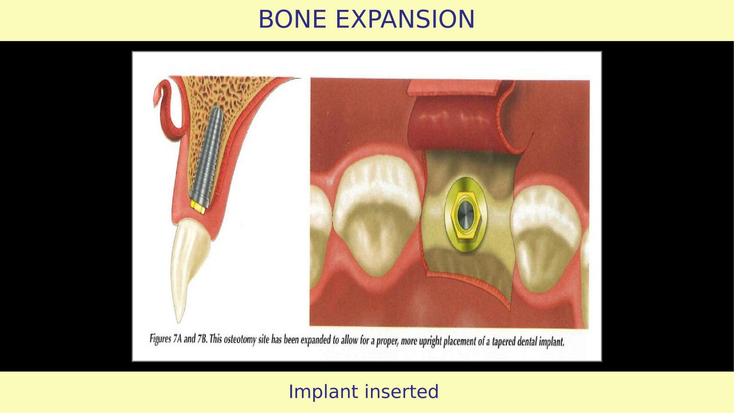 How Osteotomes Should Not Be Used — Part 1 — Slide 11