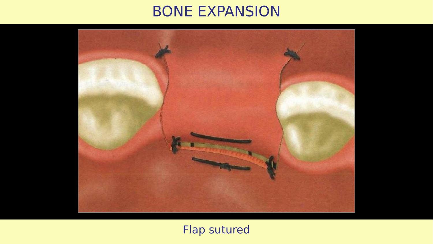 How Osteotomes Should Not Be Used — Part 1 — Slide 12