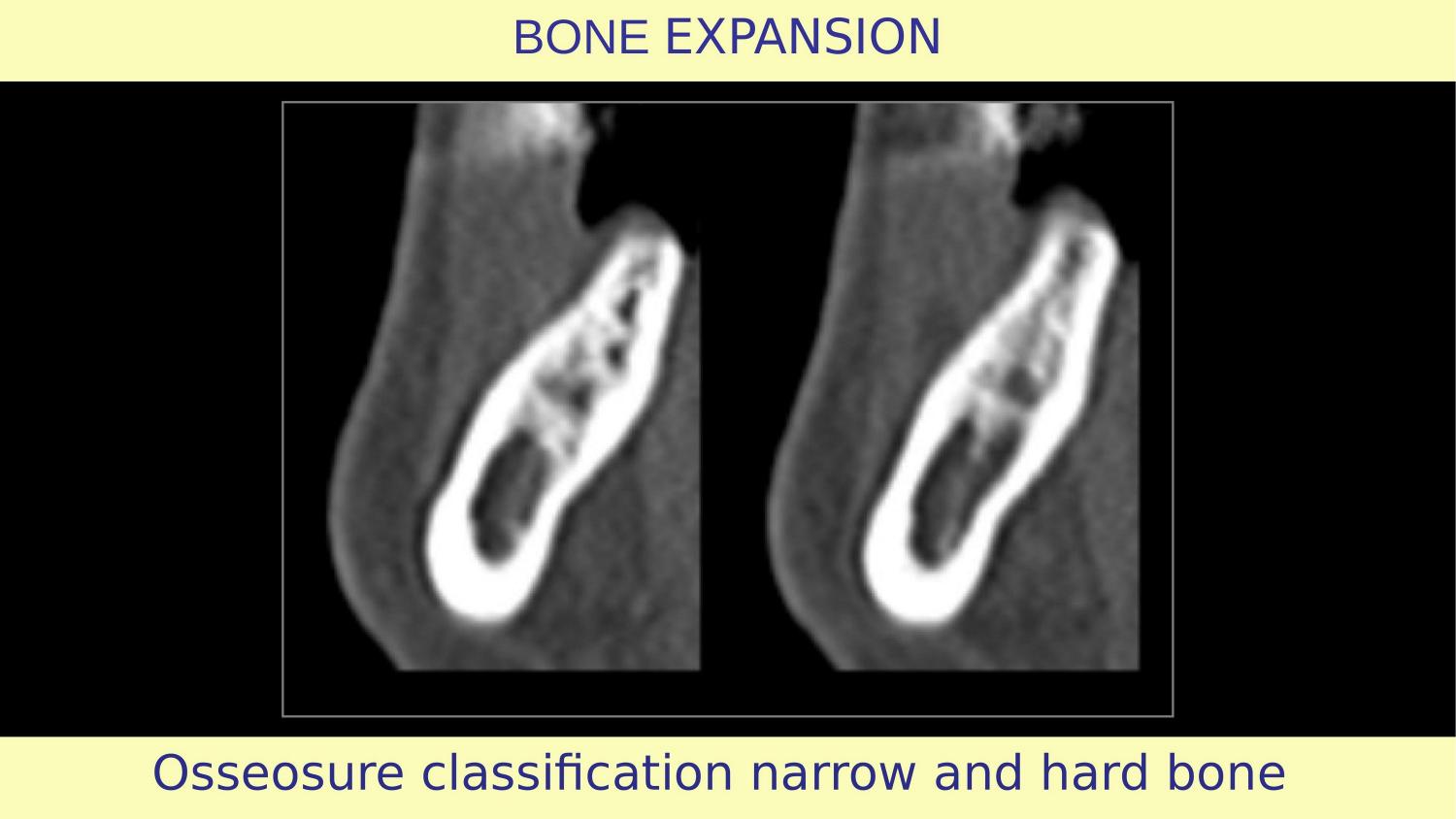 How Osteotomes Should Not Be Used — Part 1 — Slide 16