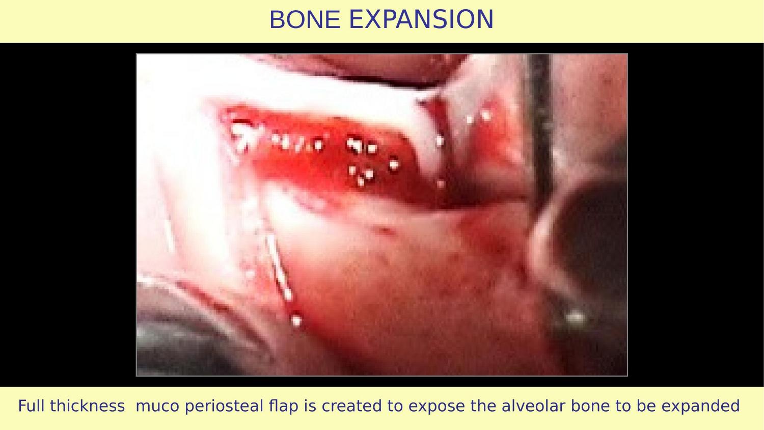 How Osteotomes Should Not Be Used — Part 1 — Slide 17