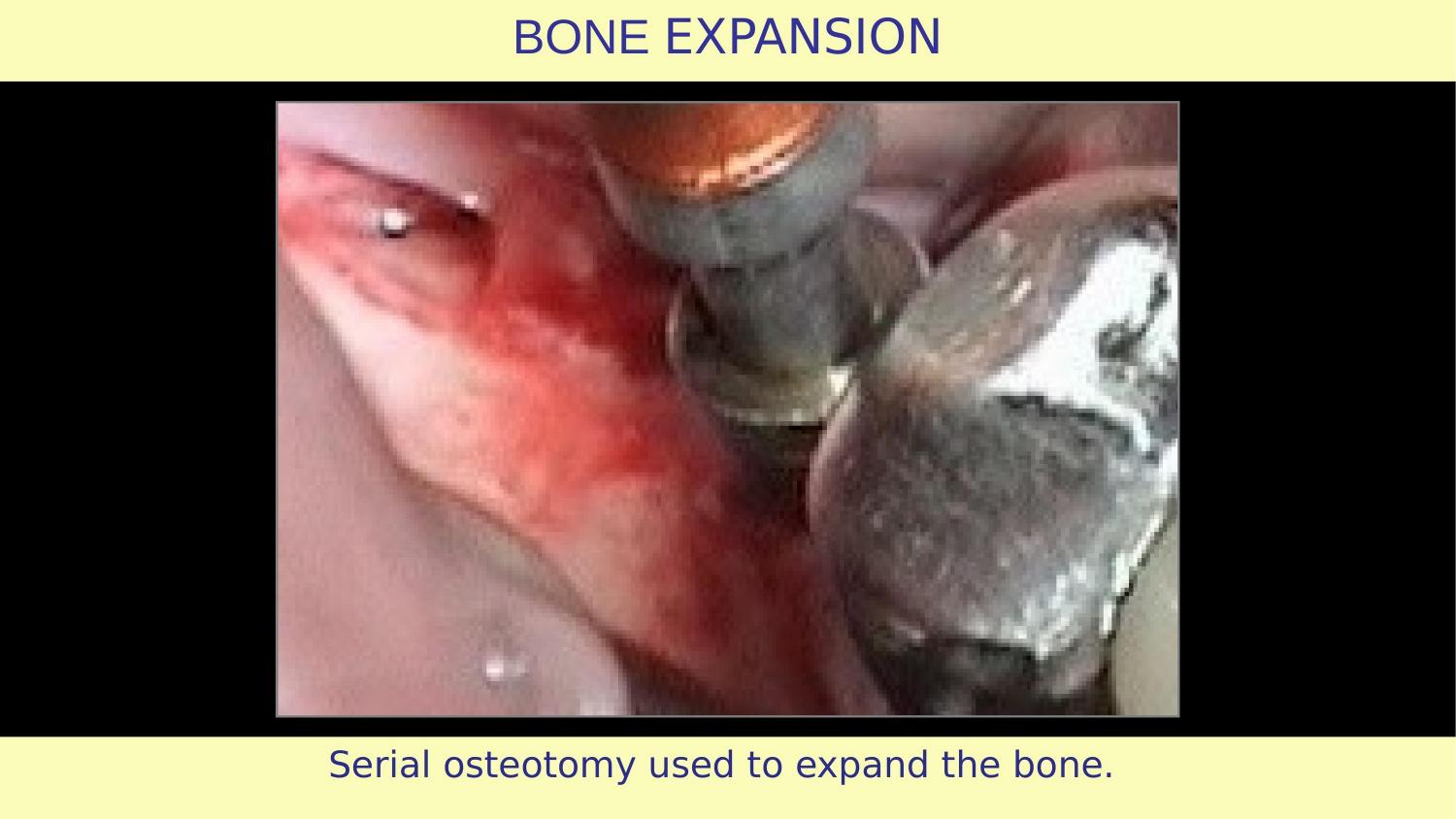 How Osteotomes Should Not Be Used — Part 1 — Slide 19