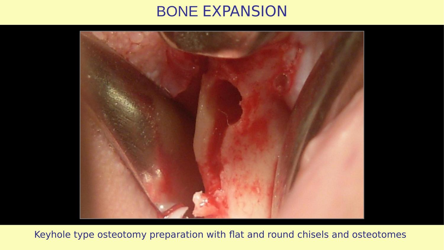 How Osteotomes Should Not Be Used — Part 1 — Slide 20