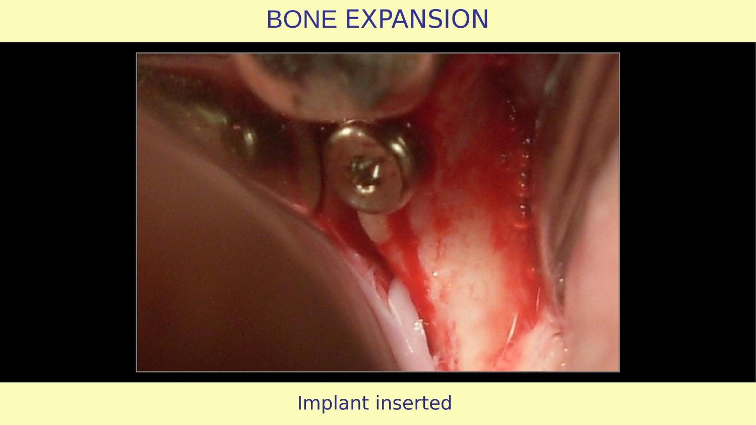 How Osteotomes Should Not Be Used — Part 1 — Slide 21