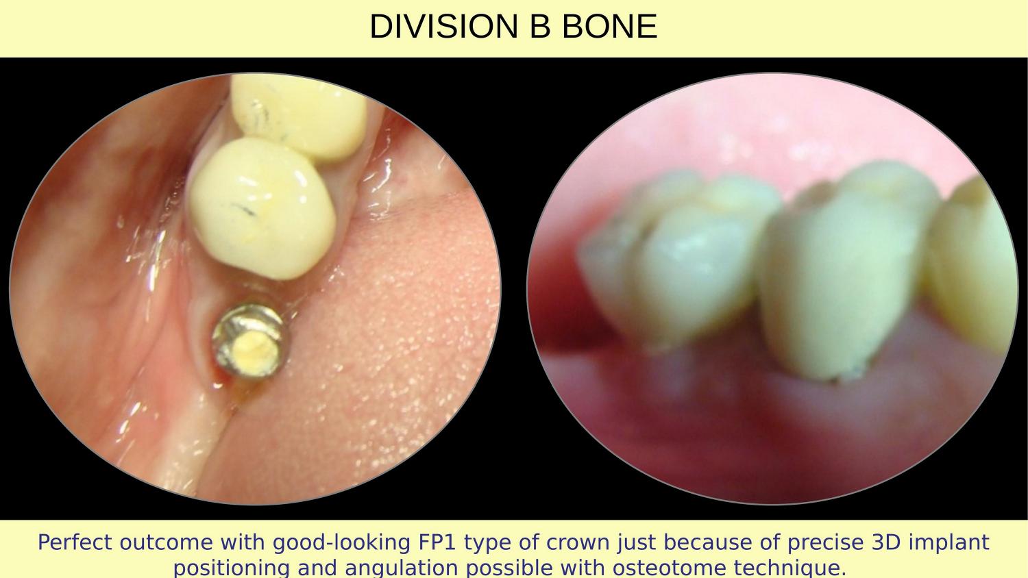 How Osteotomes Should Not Be Used — Part 1 — Slide 22